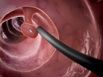 cắt polyp.png